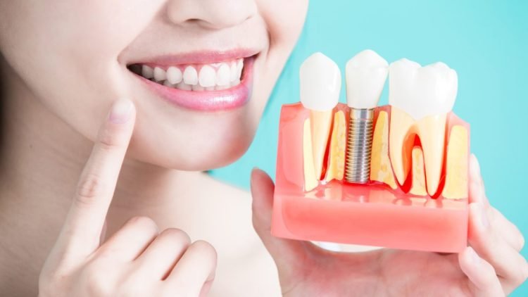 Chăm Sóc Răng Sau Khi Cấy Ghép Implant Hiệu Quả Và Đơn Giản