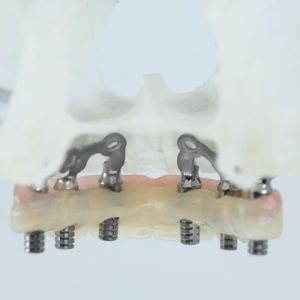 Công Nghệ Chế Tạo Trụ Implant: Đột Phá Làm Thay Đổi Nụ Cười